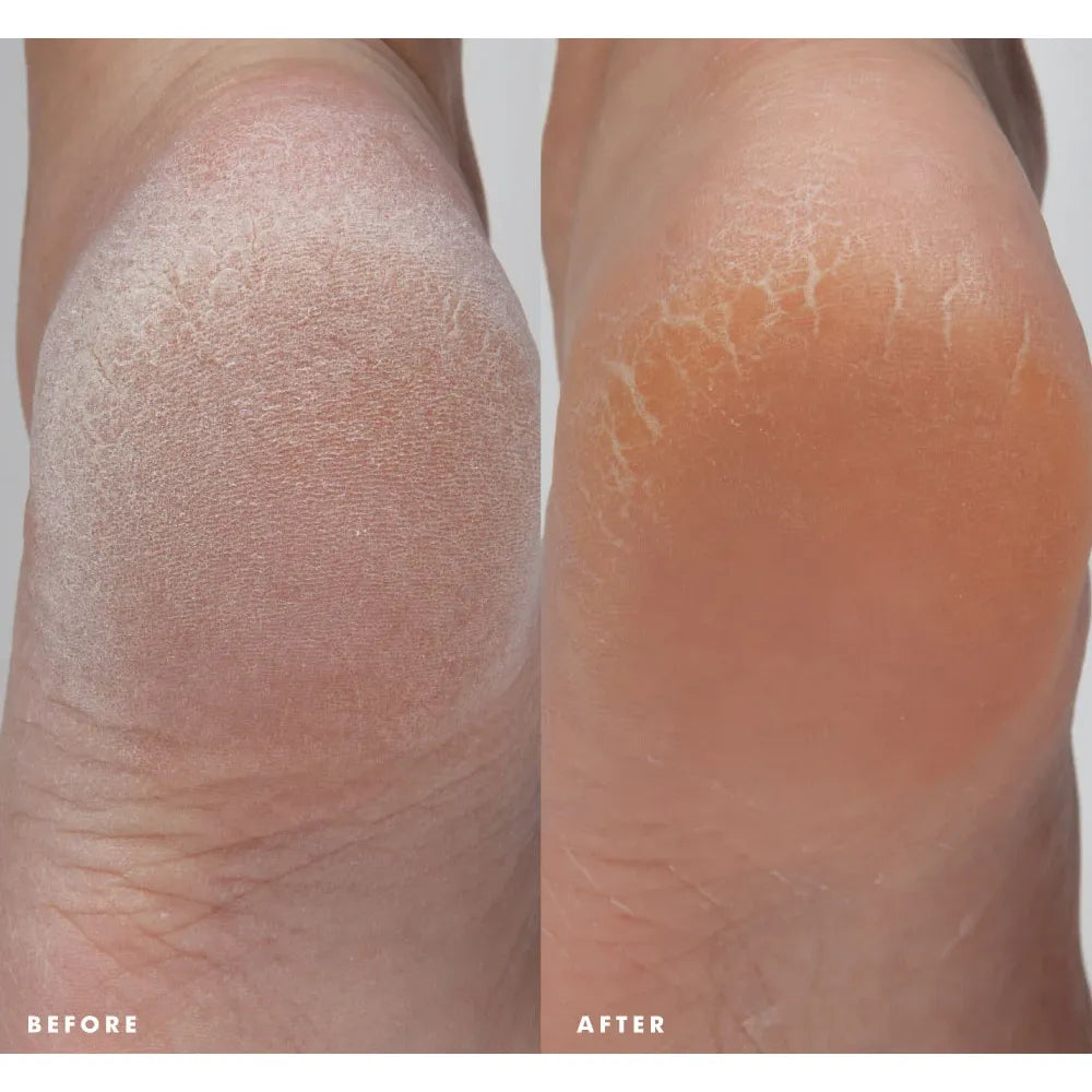 Enrich Mint® Foot Rescue Mask